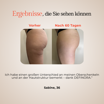 Nova Skin™ Thigh | Dual-Wellenlängen Rotlicht-Beinwrap mit 3-Lagen-Lift-Technologie™